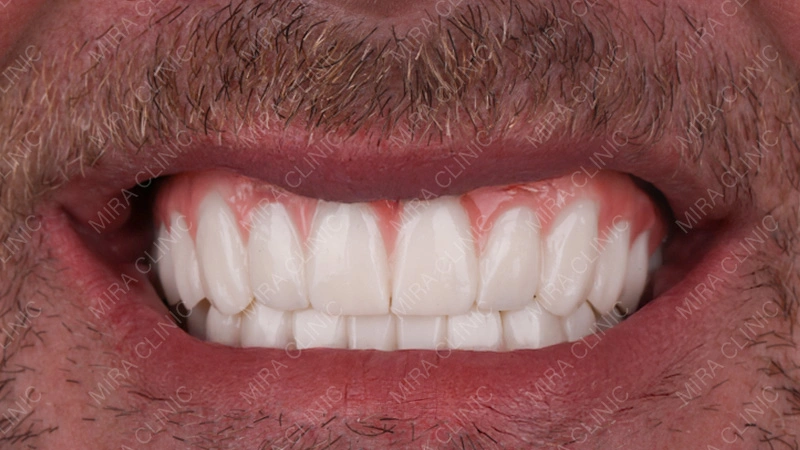 After treatment